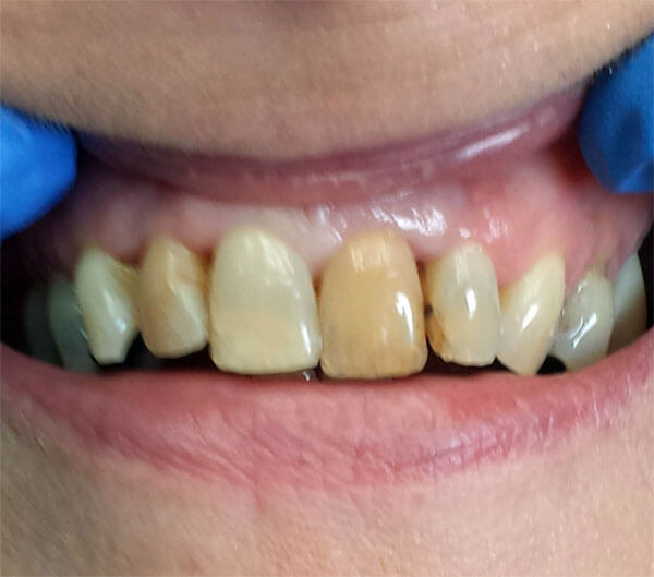 closeup cosmetic dentistry before