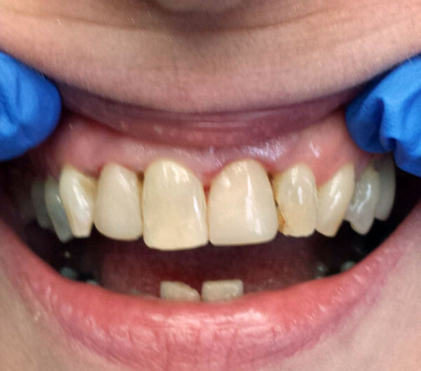 closeup cosmetic dentistry after