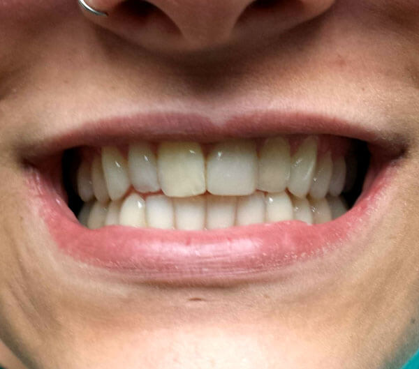 closeup cosmetic dentistry after